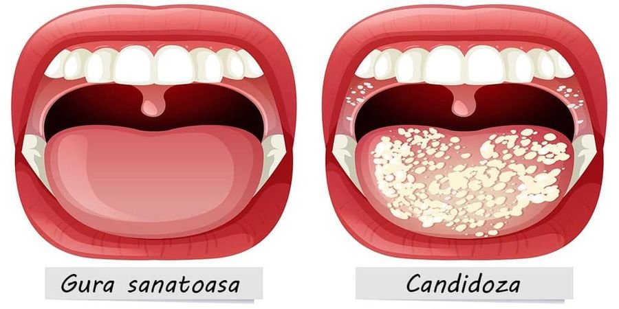 Candidoză orală