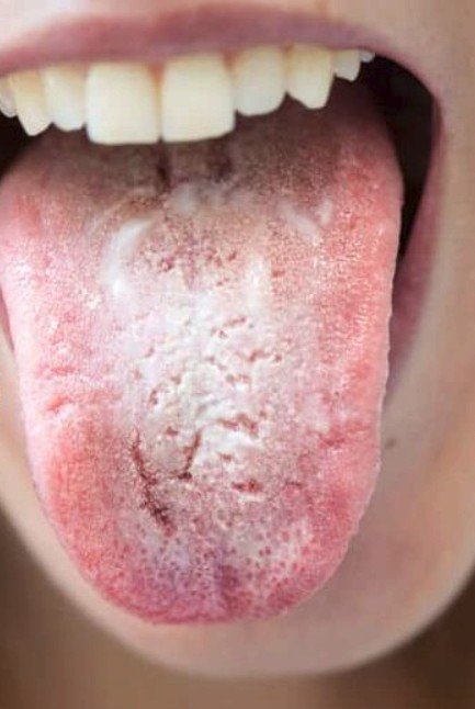 Candidoză orală