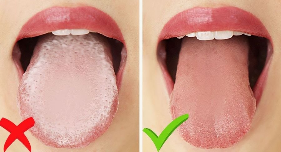 Candidoză orală